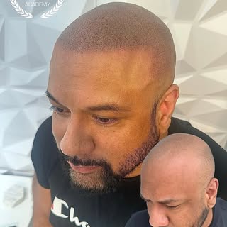 Sacramento King 👑 

#scalpco #hairtattoo 

Being bald is now optional. 👴✒️………..

5pmshadow.com 🔥�