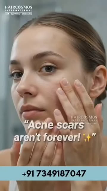 Acne scars are not necessarily forever. ✨

Those marks may look stubborn, but with the right treatme