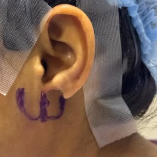 In rush to get a suture free earlobe repair or saving some few bucks often end in a mess for female 