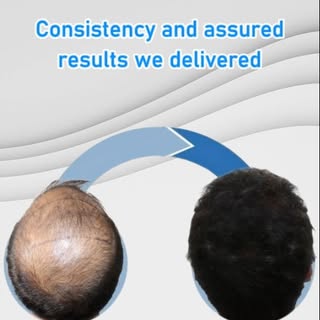 🌟 From thinning to thriving! 💇‍♂️✨
Witness the power of transformation with assured & natural-look