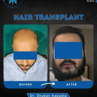 The king got his crown back

Grade 6 B baldness in a 25-year-old young man was severely affecting hi