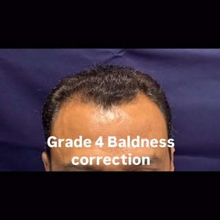 Real results. No filters. Just FUE. 🔥
Grade 4 baldness correction by the one and only Dr. Shukan Ka