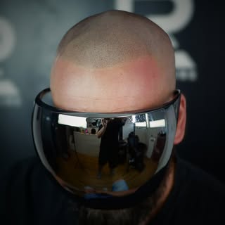 La tricopigmentation effet rasé est une solution esthétique qui reproduit visuellement l'apparence d
