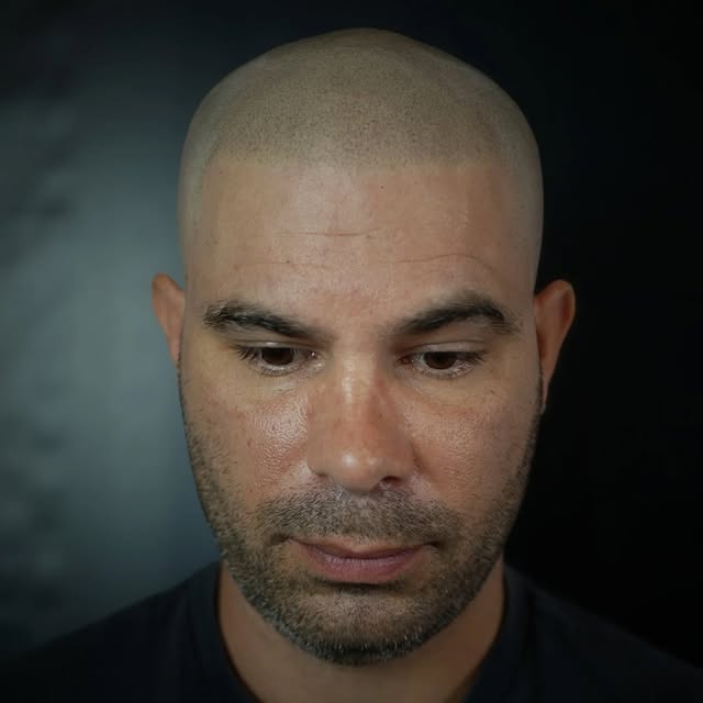 AVANT ➜ APRÈS | TRICOPIGMENTATION EFFET RASÉ

Un résultat naturel, discret et adapté à chaque visage