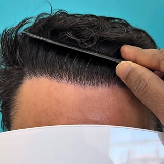 Check out the previous post for the pre-op and post-op photos. 🙌✨

#hairstyles #hairtransformation 