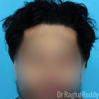 We are proud to present this 12-month post-op result for a patient who came to us with a Norwood 3. 