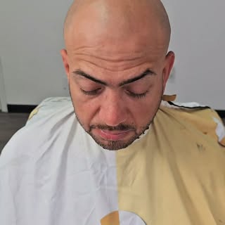 SMP la Mejor Solucion Para la Calvicie😎