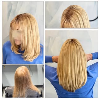 Mesh integration is a non-surgical hair replacement solution designed for women experiencing hair lo