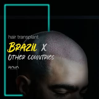 Thinking of getting a hair transplant and comparing Brazil with other countries? 
Here are 4 reasons