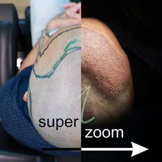 ULTRAZOOM com Dr. Marcio Ravagnani
O momento mais esperado para a análise técnica de um transplante 