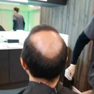 🚨 Você sabia que a coroa (vértex) precisa de mais fios no transplante capilar? 🚨

Por causa do pad
