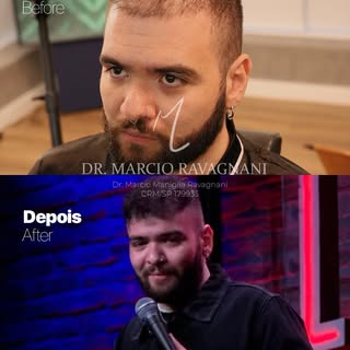💠 Dr. Márcio Ravagnani — CRM/SP 179935

Transplante Capilar • Alphaville/SP

Apenas 01 transplante 