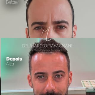 💠 Dr. Márcio Ravagnani — CRM/SP 179935

Transplante Capilar • Alphaville/SP

Apenas 01 transplante 