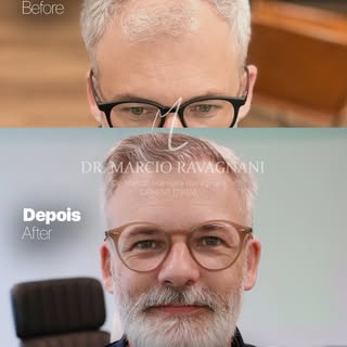 💠 Dr. Márcio Ravagnani — CRM/SP 179935

Transplante Capilar • Alphaville/SP

Apenas 01 transplante 