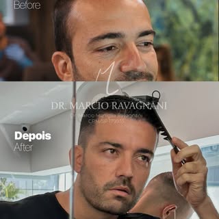 💠 Dr. Márcio Ravagnani — CRM/SP 179935

Transplante Capilar • Alphaville/SP

Apenas 01 transplante 