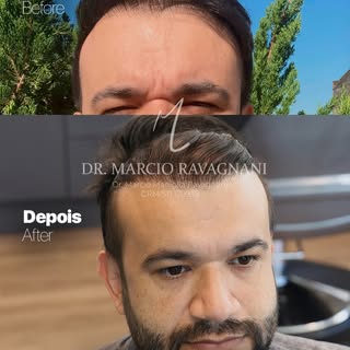 💠 Dr. Márcio Ravagnani — CRM/SP 179935

Transplante Capilar • Alphaville/SP

Apenas 01 transplante 