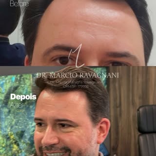 💠 Dr. Márcio Ravagnani — CRM/SP 179935

Transplante Capilar • Alphaville/SP

Apenas 01 transplante 