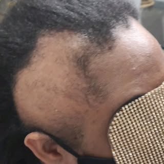 Se ela soubesse que tantos anos fazendo alongamento apertado iria causar #alopeciadetracao certament