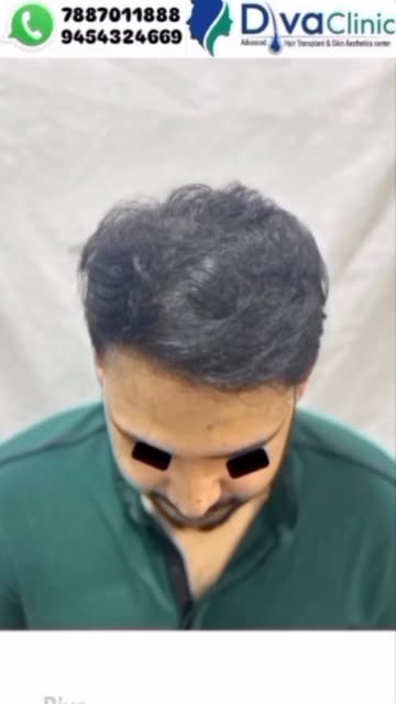 ✨ Say goodbye to thinning hair and hello to natural, dense volume!Witness this incredible 3500-graft
