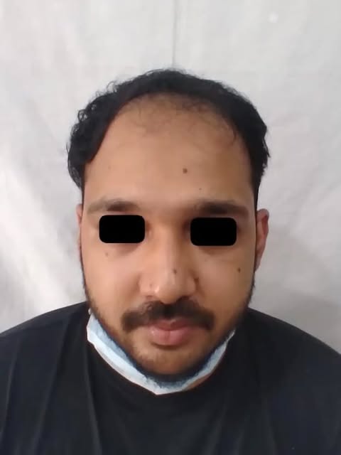 Grade 5 Baldness/3500 FUE grafts/9 months results. 

28 year male operated for hair transplant where
