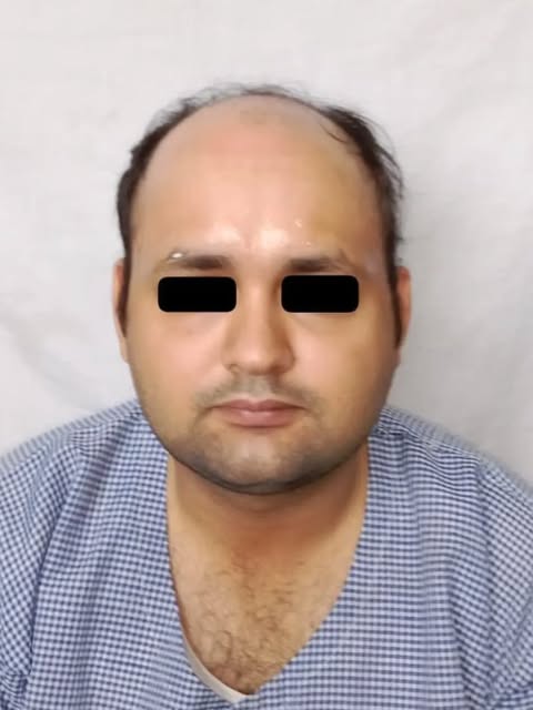 A natural looking hair line reconstruction in Grade 7 norwood baldness with 7000 FUE grafts containi