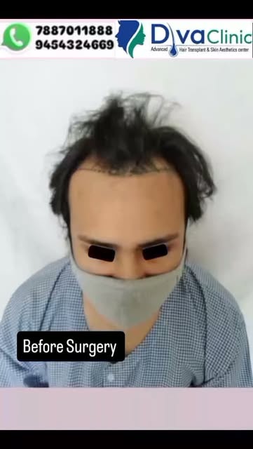 After 1 year result
