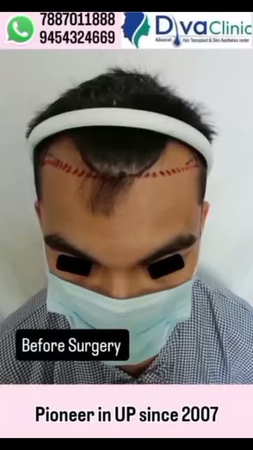 After 9 months result of hair transplant