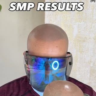 Healed smp results and ready to go for final touch up 
Call for more details 8151867186
@scalpdots #