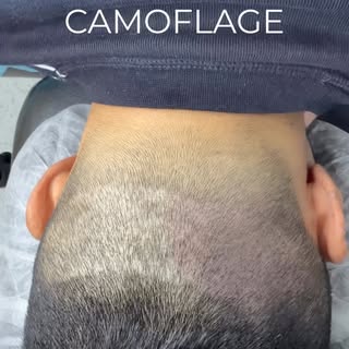 Scalp Micropigmentation (SMP) scar camouflage is an advanced, non-surgical treatment that blends FUT