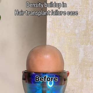 🇬🇧 From the UK to India for Confidence That Lasts! 🇮🇳✨

Three years after his hair transplant, o