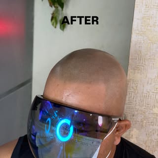 🔥 ALL THE WAY FROM MANIPUR TO SCALPDOTS! 🔥

When hair loss affects confidence, distance becomes ju