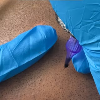 Scalp micropigmentation in process 
#scalpmicropigmentation #smp #scalpmicropigmentationindia #scalp