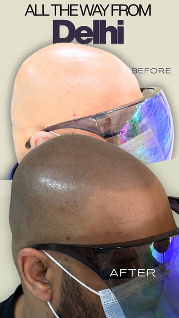 From Delhi to Pune for a life-changing transformation! 🔥

Our client came to Scalpdots with Grade 7