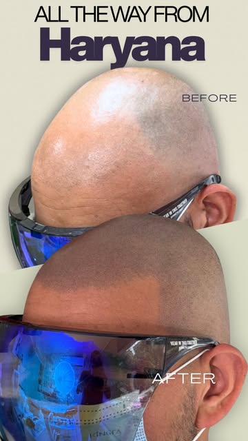 All the way from Haryana to Scalpdots! ✈️

Our client underwent a hair transplant but still had visi