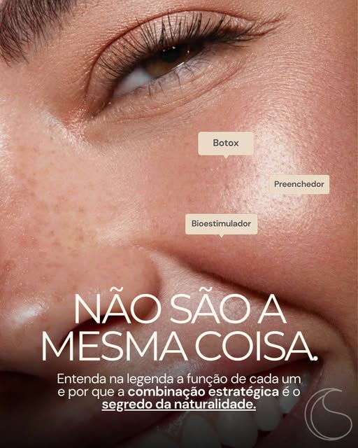 Botox, preenchedor e bioestimulador não fazem a mesma coisa. E entender essa diferença é essencial p