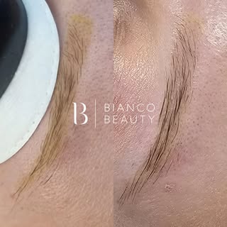 Yellow pigment in semi-permanent eyebrows is one of the most difficult colours to remove. Unlike dar