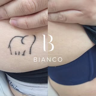 Forget your unwanted ink with expert tattoo removal at Bianco Beauty ⚡️

Book a consultation with ou