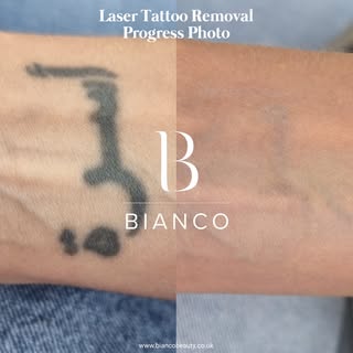 If you have a very deep, saturated tattoo you may think you'll never be able to achieve an effective