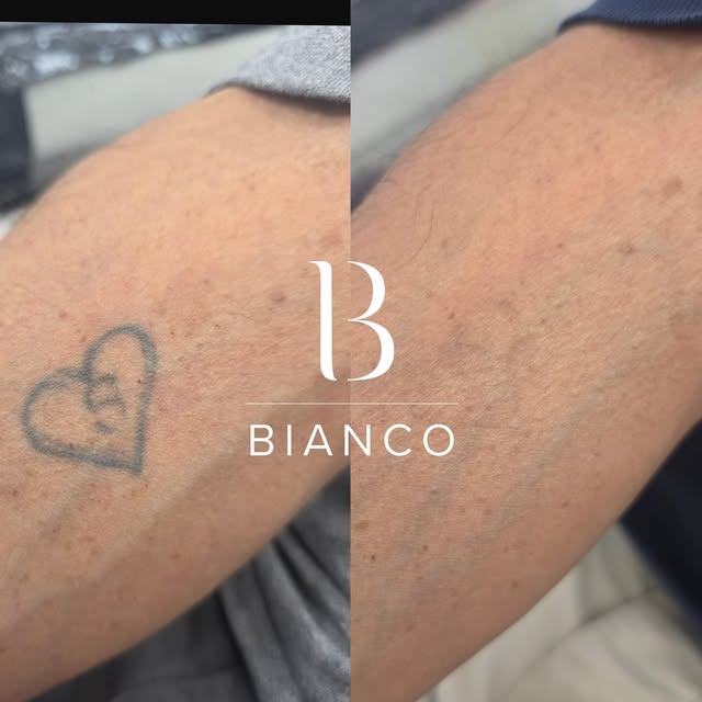 Whether you want all traces of your tattoo gone completely, or you just want it faded enough that it