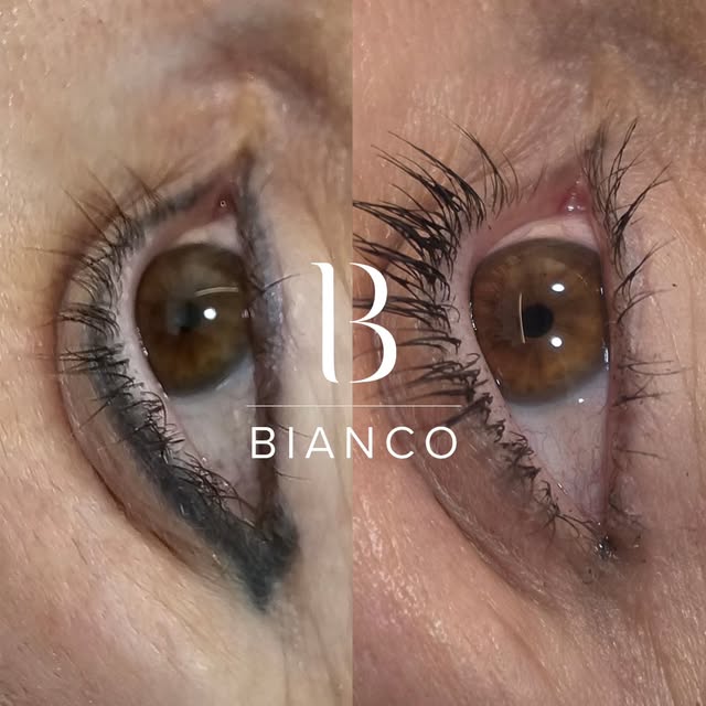 With eyeliner removal, every journey is different. The number of sessions needed depends on several 