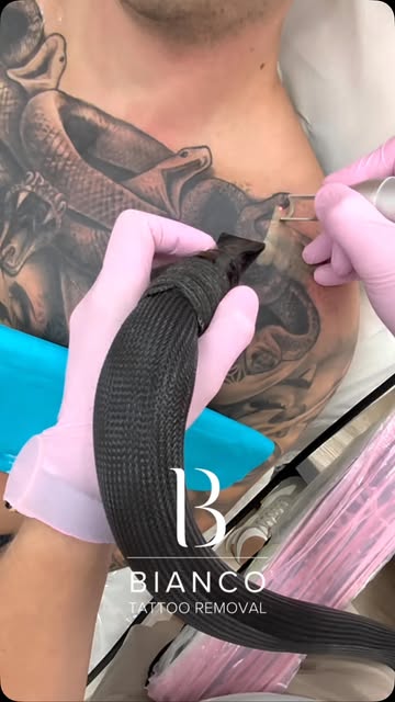 A lot of our clients tell us how much they love watching the frosting process during laser tattoo re