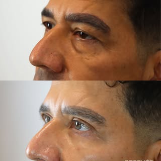Una mirada más fresca, masculina y descansada. ✨

Este antes y después de blefaroplastia demuestra c