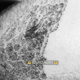 Un golpe después de un implante capilar puede afectar seriamente el proceso de recuperación y el res