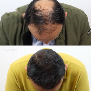 Restauración completa con resultados naturales 👨‍⚕️ tu proceso de implante capilar en manos experta