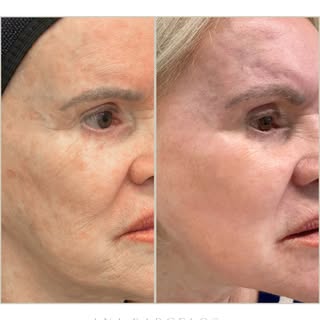 Resultado de um peeling realizado sob sedação e bloqueio anestésico ✨

Essa paciente querida se inco
