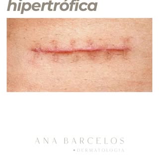 Toda cirurgia deixa cicatriz.Mas algumas podem evoluir com vermelhidão, endurecimento, relevo ou alt