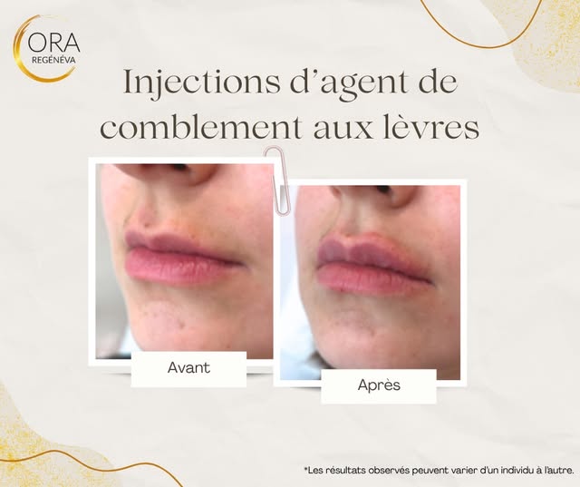 💋 Les injections d’acide hyaluronique permettent de restaurer le volume, redéfinir le contour et hy