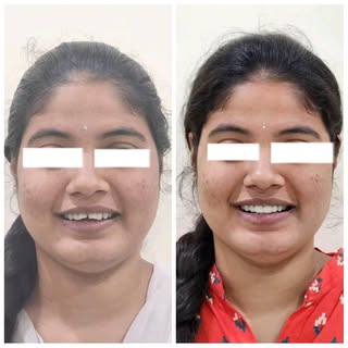 Smile transformation creates emotional journeys !! - Bunny teeth Correction using Premium Zirconia C
