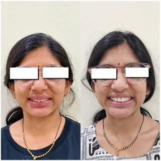 Magic is in the hands of the master. Redoing the crowns of a patient to get back the smile she wants