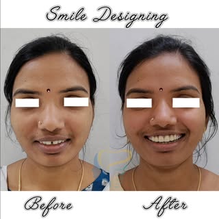 Can't believe we almost missed posting this stunning Smile Design transformation with 3M Lava crowns